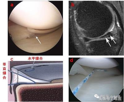 关节炎滑膜炎骨质增生能治好吗,髌骨关节炎骨质增生就是滑膜炎吗