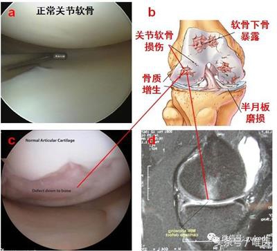 关节炎滑膜炎骨质增生能治好吗,髌骨关节炎骨质增生就是滑膜炎吗