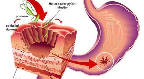 全国有最多的胃癌患者,全国胃癌最好的行家是谁