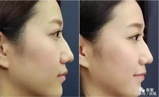 杨紫瘦了腿显得不纤细,杨紫变美之路脸怎么瘦的