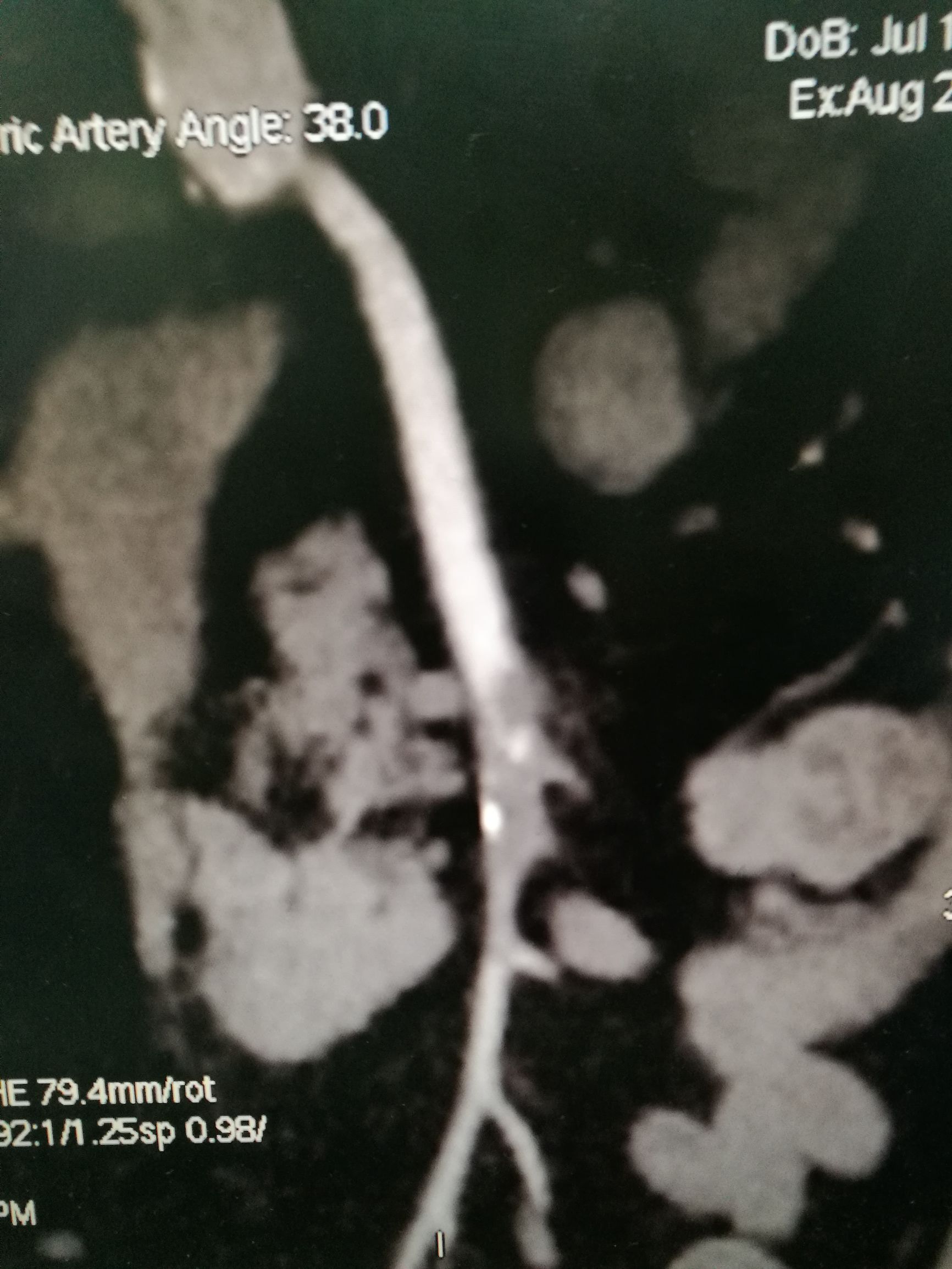 要命的肠缺血被轻松化解