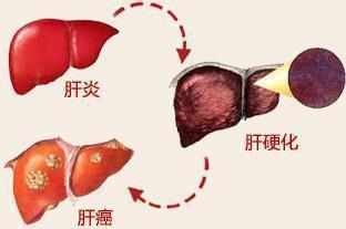 转氨酶高可能是什么病,转氨酶高是重大疾病吗