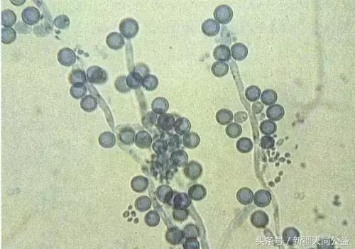 艾滋病的口腔表现症状,艾滋病口腔里有hiv吗