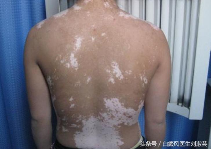 白癜风用补骨脂泡酒擦有功能吗,补骨脂和白蒺藜治白癜风