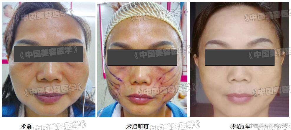 小切口线雕面部提升术视频,线雕面部提升术危害
