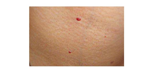 红痣的出现民间意味着什么,突然冒出来的红色痣怎么处理