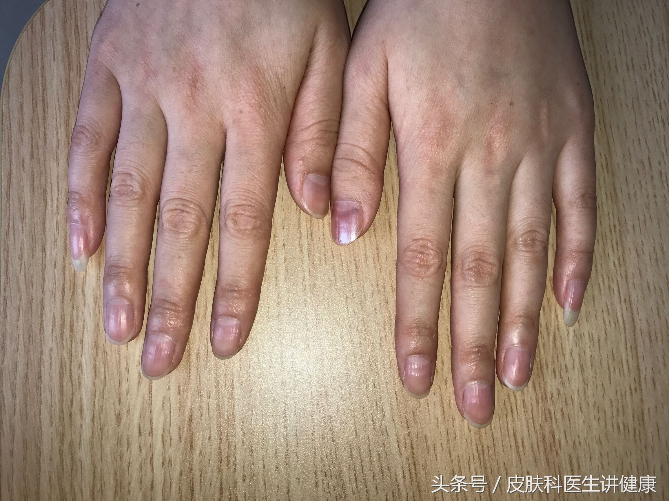 手上有脚气起小水泡痒,儿童脚气痒脱皮有小水泡怎样治疗