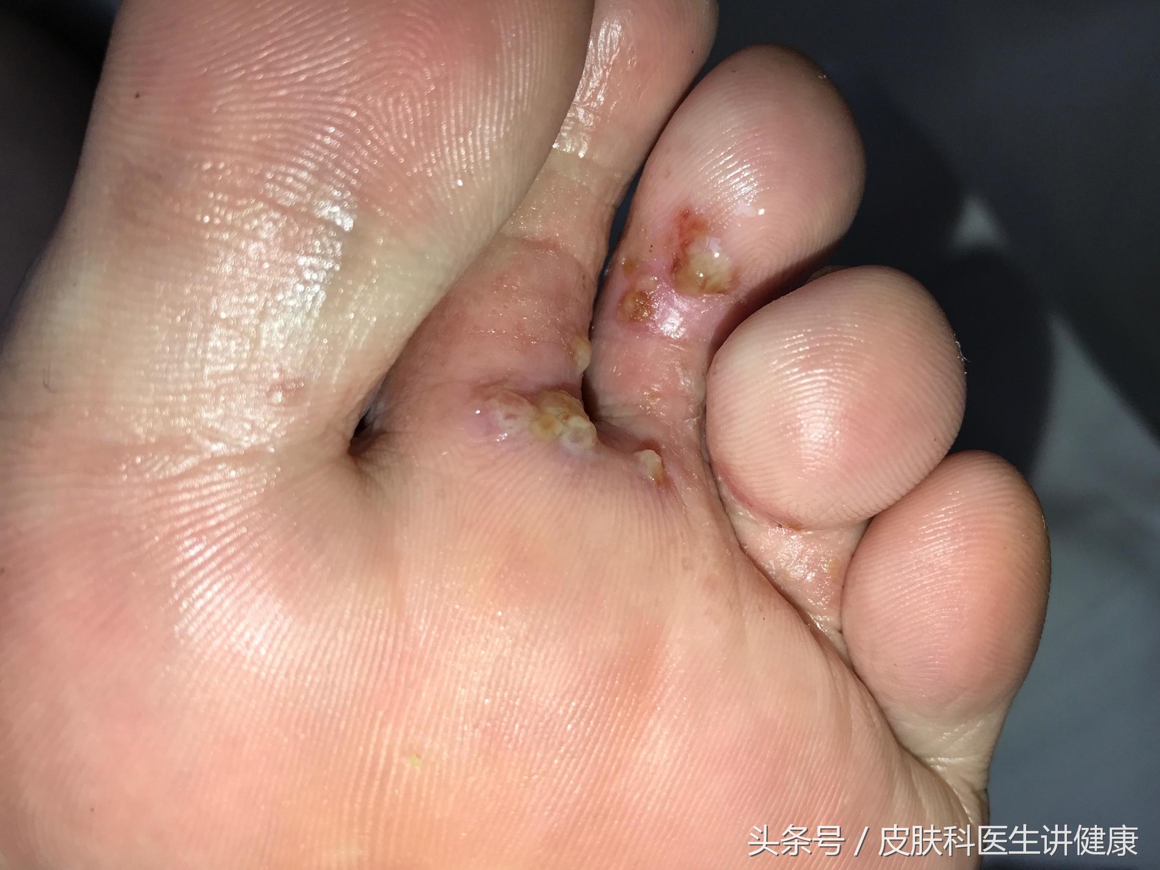 手上有脚气起小水泡痒,儿童脚气痒脱皮有小水泡怎样治疗