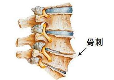 骨质增生骨刺怎么治疗能根除,骨质增生怎么治才能彻底治好骨刺