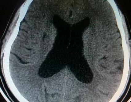 脑梗塞后遗症肢体康复训练,周口脑梗塞后遗症康复医院哪个好