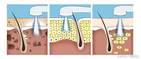 光电美肤美容项目,光电美肤效果怎么样