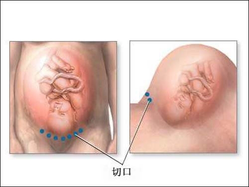 剖腹产麻醉对身体副功能,剖腹产麻醉对身体的危害