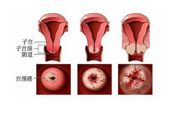 案例分享：宫颈上皮内瘤变的诊断和治疗，该如何预防宫颈癌？
