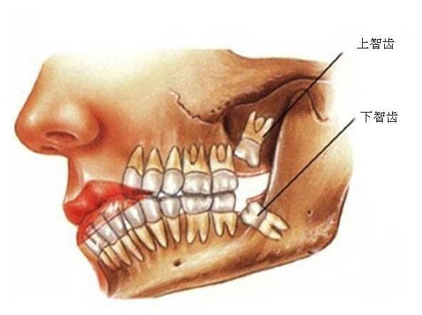 长智齿受凉后牙龈肿痛怎么办,长智齿牙疼怎么办最快最有效
