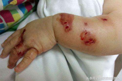 踩了生锈的钉子一定会得破伤风,踩到带锈的铁钉一定会得破伤风吗