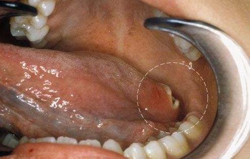 还需高度警惕口腔癌,口腔癌的真正罪魁祸首
