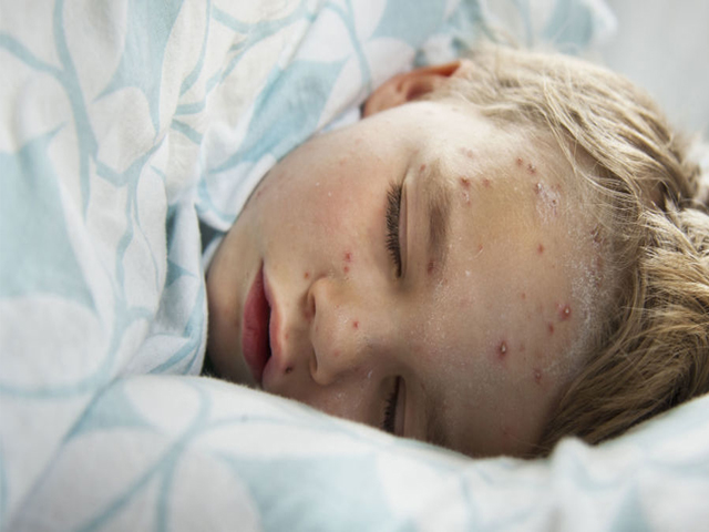 儿童水痘是怎么引起的,孩子得水痘大人如何避免传染