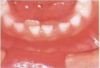 蛀牙的修补和牙齿矫正的问题,爱牙日公益讲座视频