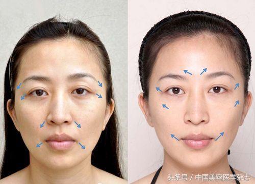 超声刀能够除皱吗,超声刀后面部凹陷还能恢复吗