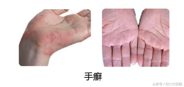 手上起小水泡是什么病,手上长小水泡一挤就流水是什么病