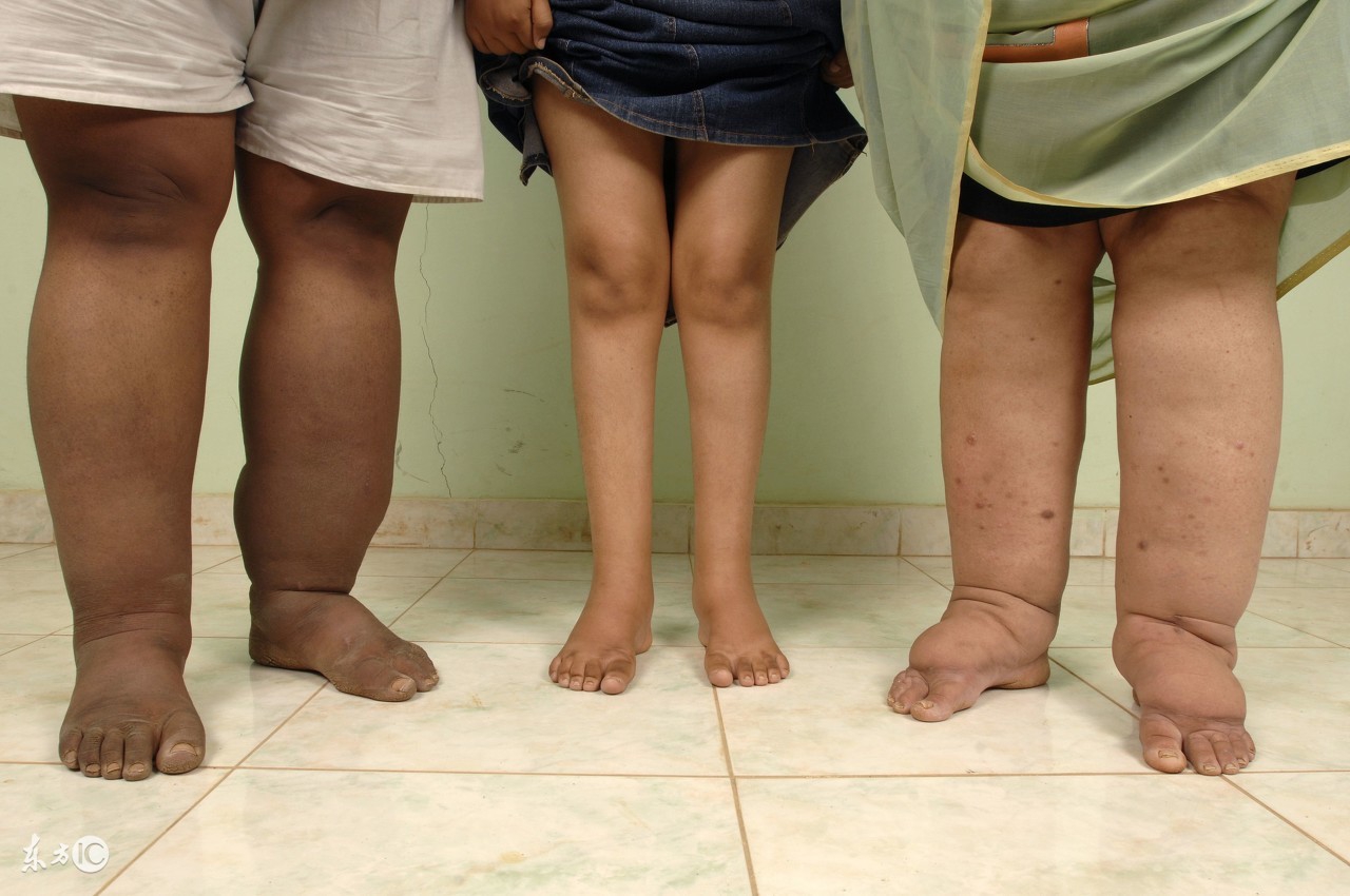 双腿浮肿要吃啥药才好得快呢,双腿酸胀湿气重吃什么药