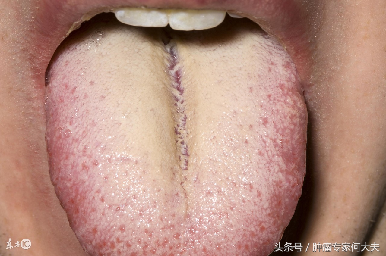 看舌象判断病靠谱吗,看舌苔判断身体癌症