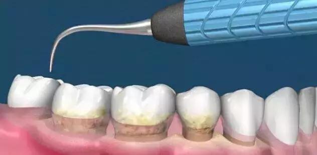 牙齿矫正出现黑三角,儿童牙齿矫正会出现黑三角吗