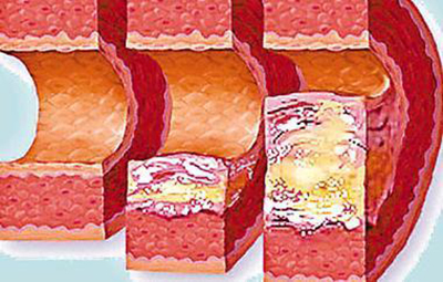 半导体激光真的能够降血压降三高,血液净化能治疗高血压吗