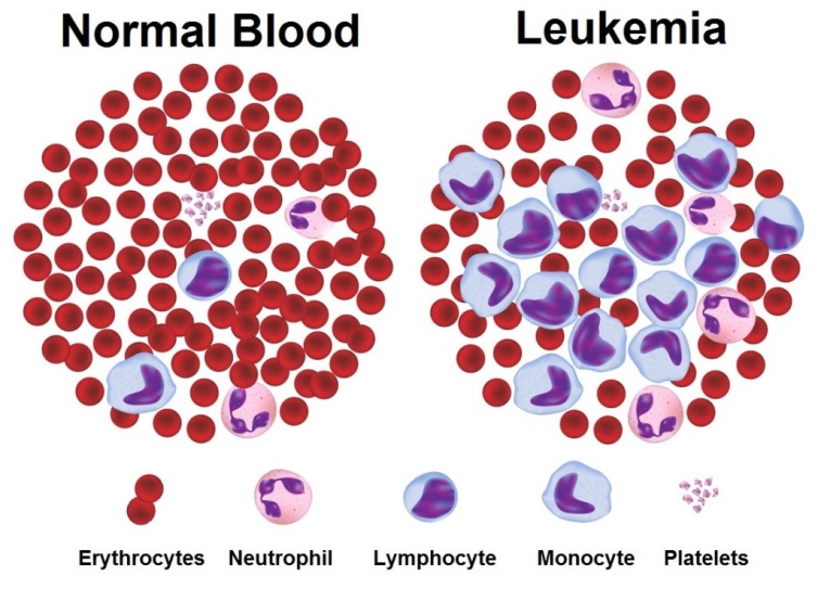 白血病干细胞研究,白血病中西医治疗与研究进展论文