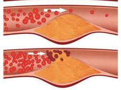 弱激光治疗心脑血管病,弱激光体外治疗仪器