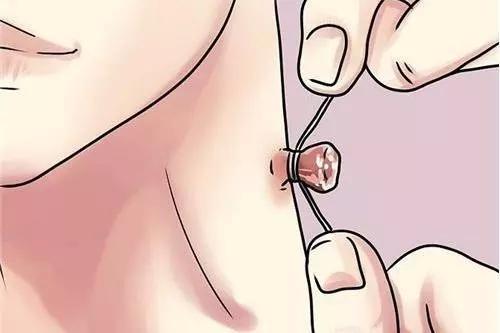 脖子上小揪揪能够剪掉吗,脖子上的小揪揪自己会掉吗