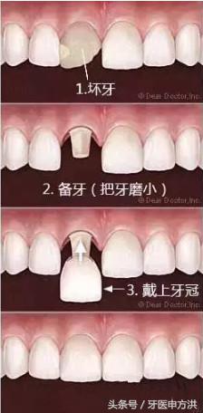 烤瓷牙边缘变黑了怎么修复,烤瓷牙真牙变黑了怎么处理