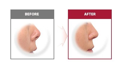 鼻子整形的方法有几种,鼻子整形能改变容貌吗