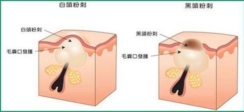 严重粉刺的最佳治疗方法,粉刺怎么治疗最有效的方法