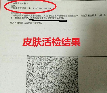 脑袋长疖子的最佳治疗方法,头皮上长了一个火疖子