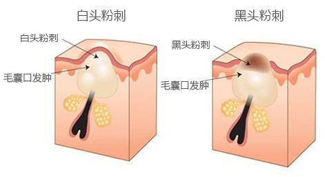 姣涘瓟绮楀ぇ榛戝ご绮夊埡娓呮磥闈㈣啘,鎬庝箞娑堢伃榛戝ご绮夊埡姣涘瓟绮楀ぇ