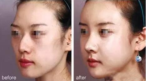 一张图让你全面了解鼻综合整形,鼻综合整形后鼻子一般多久消肿