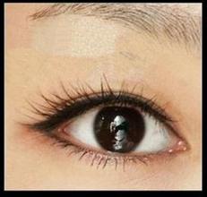 激光矫正近视手术过程是怎么样的,激光矫正近视手术危害有多大