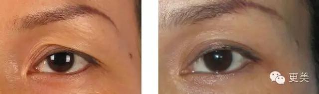 抬头纹手术会不会影响眼睛,抬头纹手术后有后遗症吗