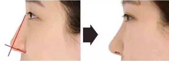 一张图让你全面了解鼻综合整形,鼻综合整形后鼻子一般多久消肿