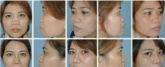 一张图让你全面了解鼻综合整形,鼻综合整形后鼻子一般多久消肿