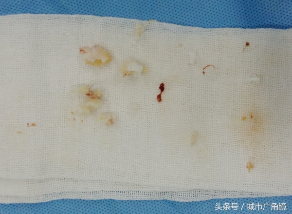 医院开的外敷药能治疗骨刺吗,膏药能彻底根治骨刺