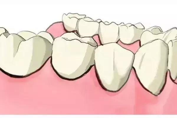 缺牙是种植牙还是烤瓷牙好,烤瓷牙和种植牙哪个保持时间长