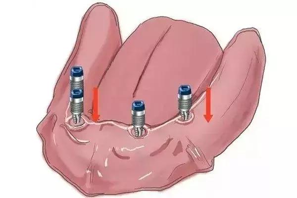 缺牙是种植牙还是烤瓷牙好,烤瓷牙和种植牙哪个保持时间长