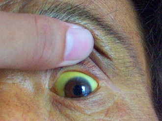 眼球凸出眼睛是变大还是变小,眼球正常是凸出来多少