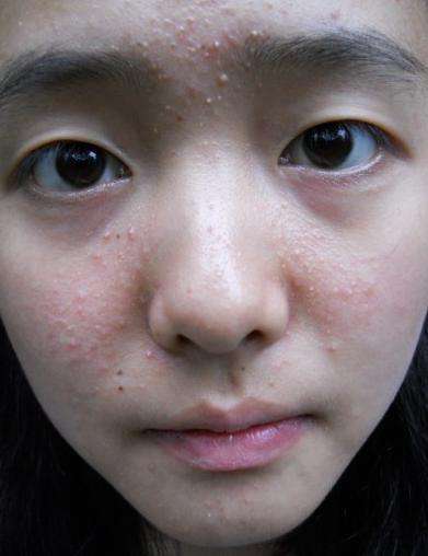 脸上长满了闭合性闭口粉刺怎么办,什么是闭口粉刺什么是痘痘