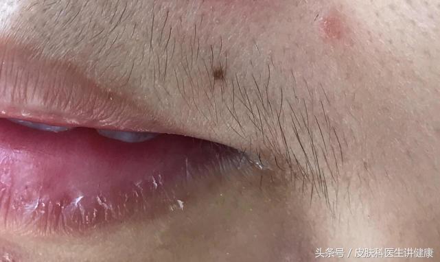 一公分的痣能够做手术切除吗,去医院医生说痣太大了只能做手术