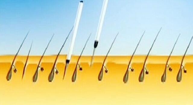 植发必须取后枕部的毛囊吗,植发提取毛囊的部位还能长头发吗