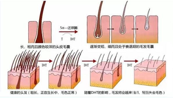 植发必须取后枕部的毛囊吗,植发提取毛囊的部位还能长头发吗