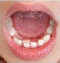 儿童换牙后的乳牙如何处理,儿童换牙期乳牙滞留怎么办